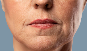 Lip lift directo imagen