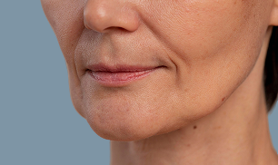 Lip lift indirecto