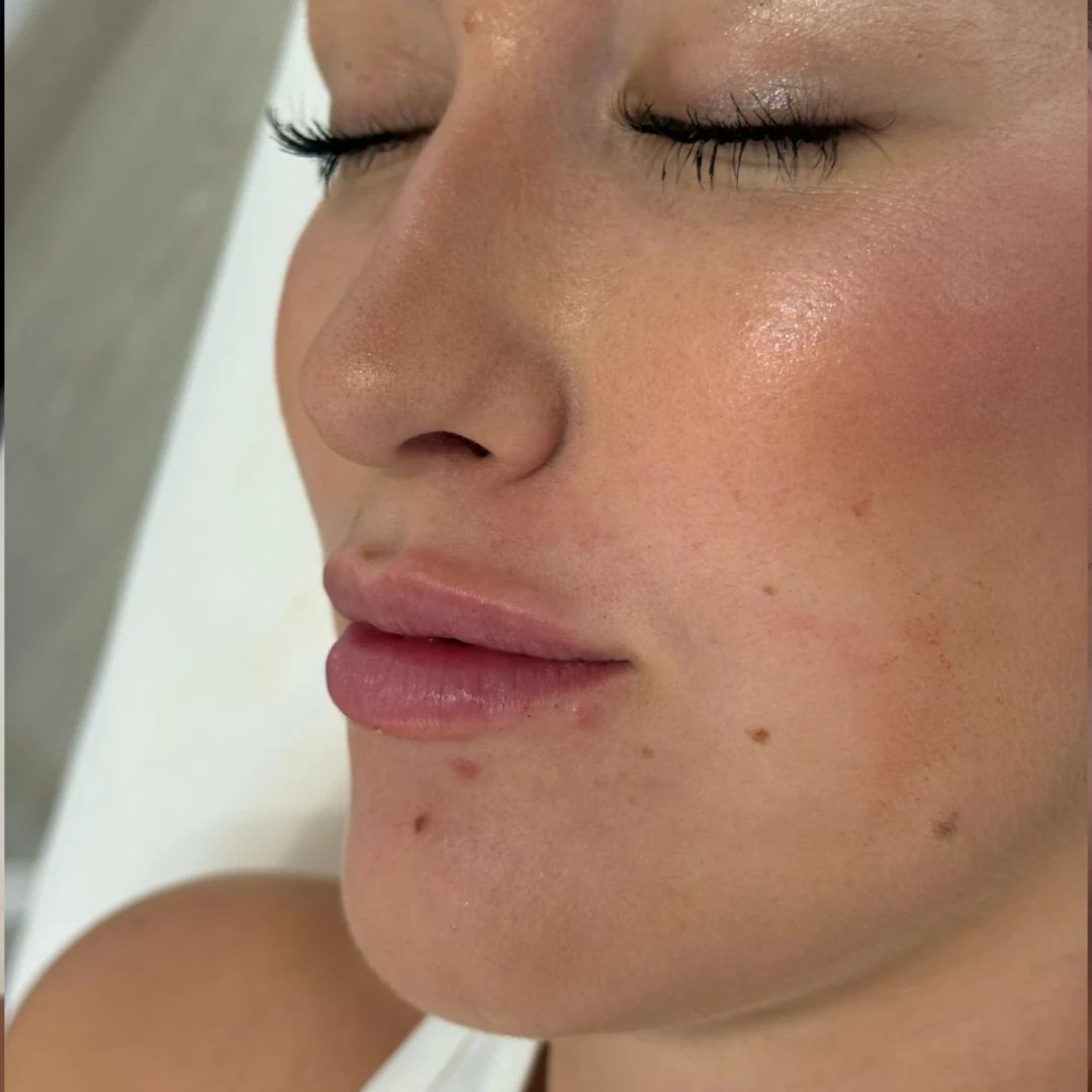 despues labios 1