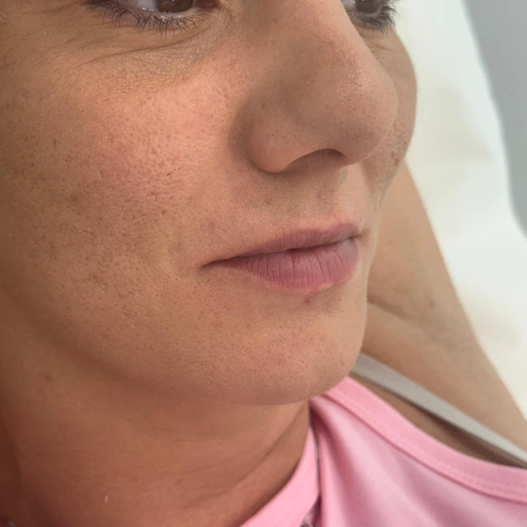 Polinucleótidos en Córdoba 2 labios antes 1