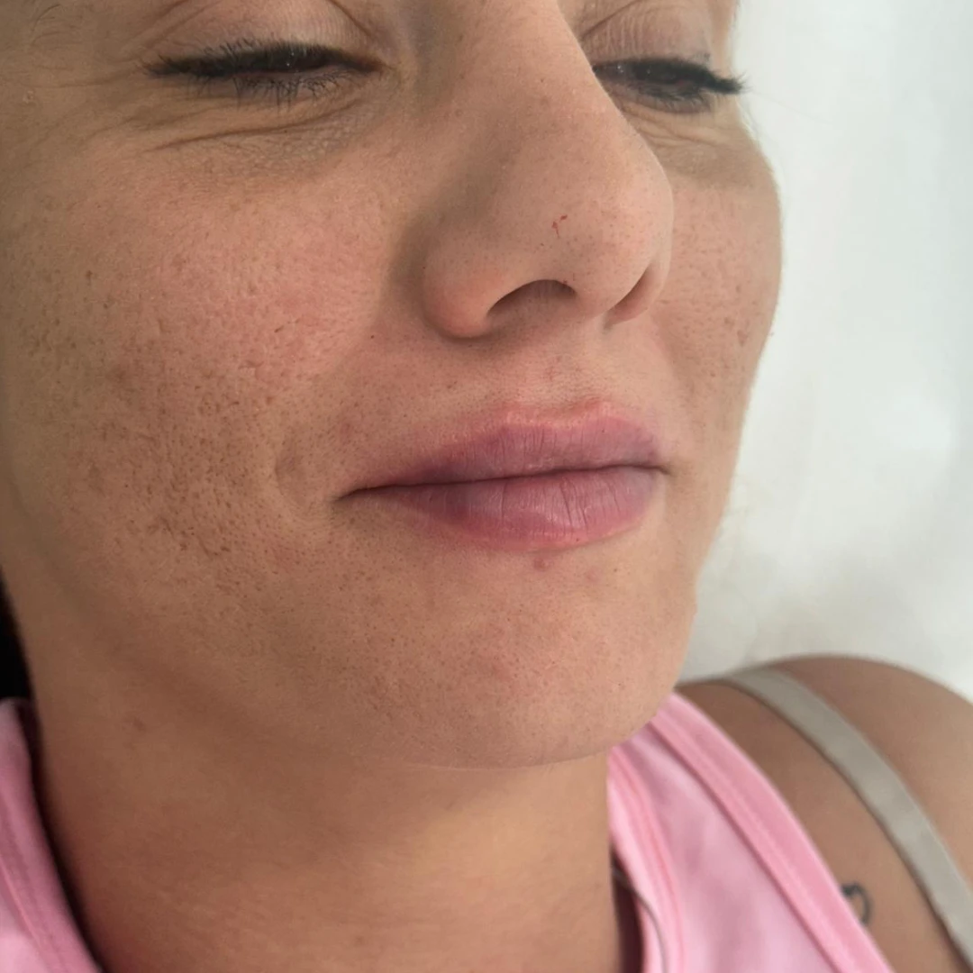 labios despues 1