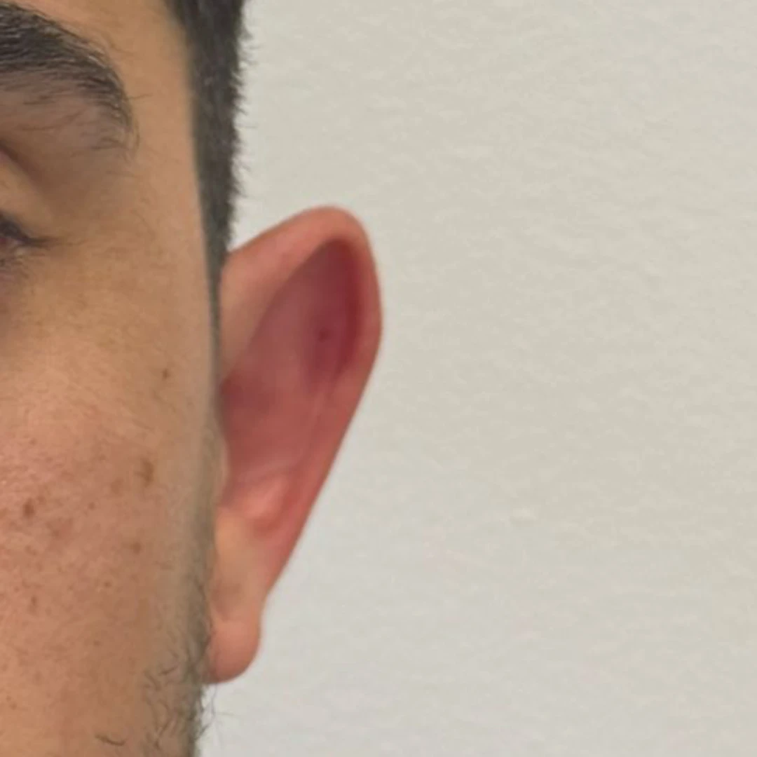 Polinucleótidos en Córdoba 4 oreja antes 1