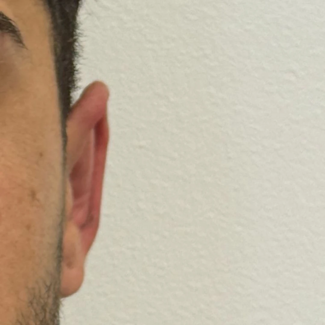 oreja despues 1