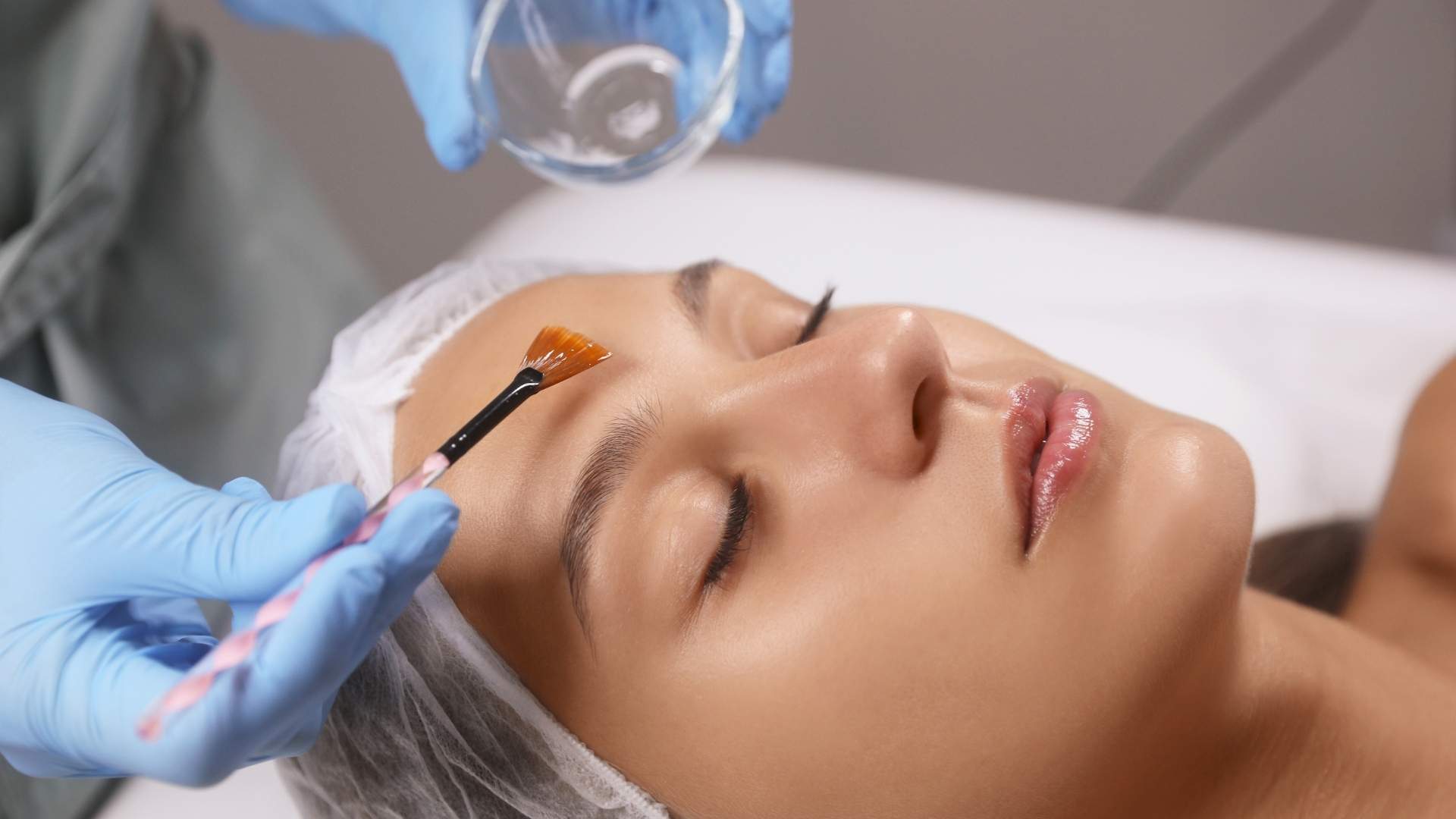 todo sobre peeling quimico