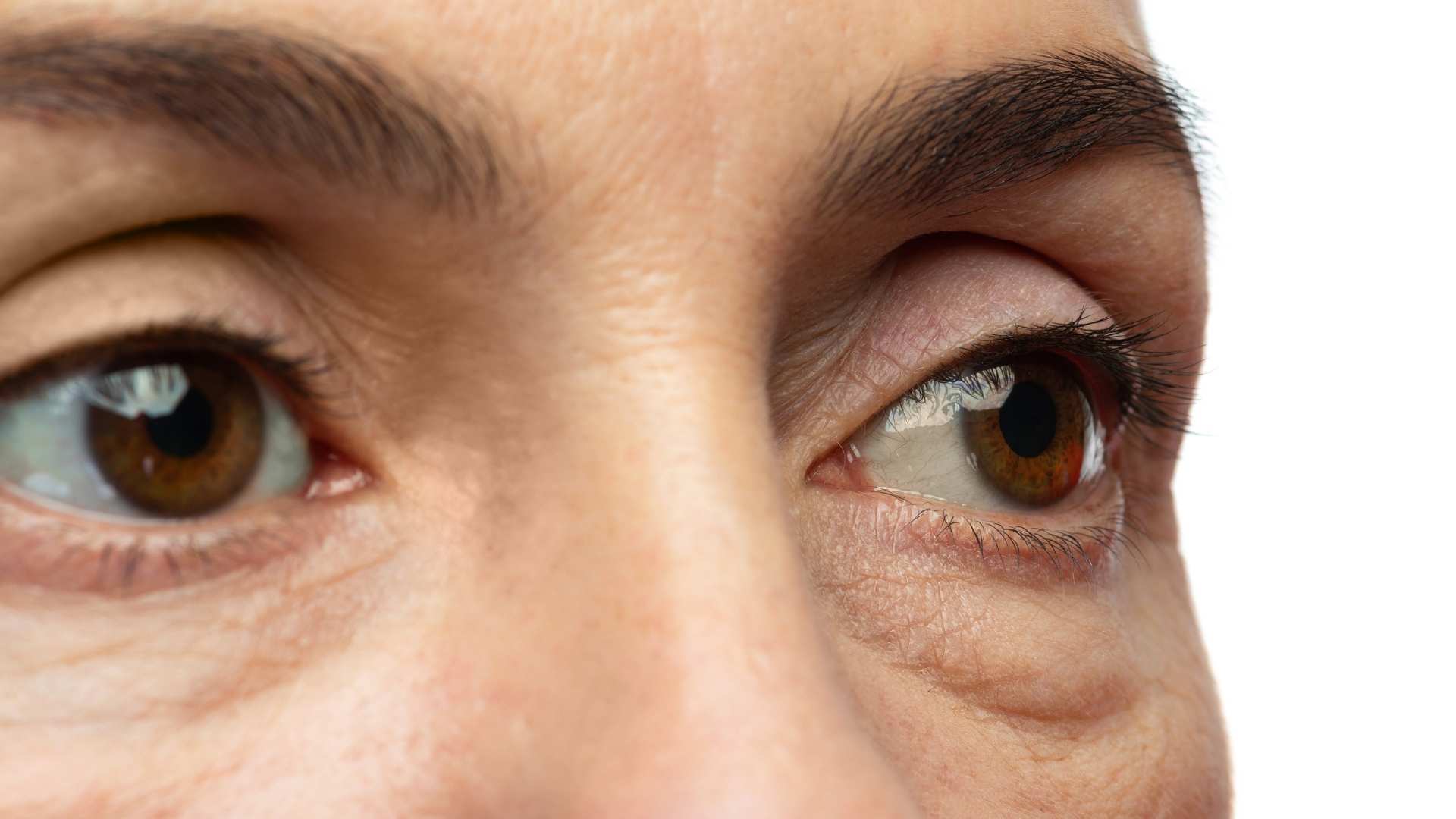 Eliminar ojeras hundidas con ácido hialurónico